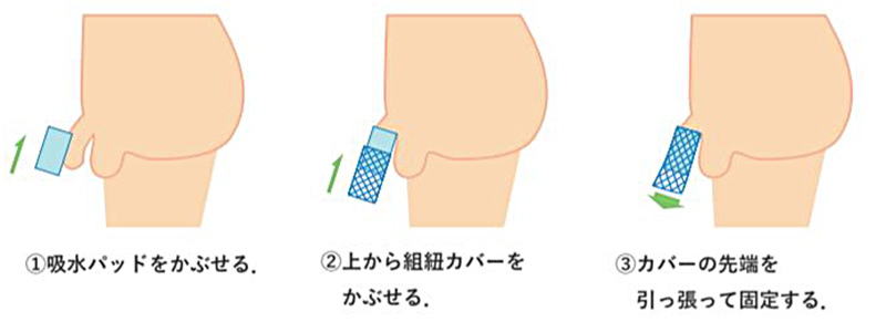 ①吸水パッドをかぶせる．②上から組紐カバーをかぶせる． ③カバーの先端を引っ張って固定する．|組紐尿取りパッド - 若年層脊髄損傷患者用下着の提案-